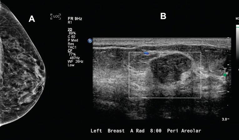 What Is Breast Ultrasound And When Should One Be Done?