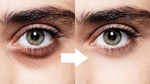 Dark Circles And Their Causes