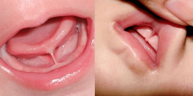 Navigating Tongue and Lip Release